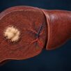 Liver Cancer