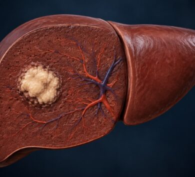 Liver Cancer